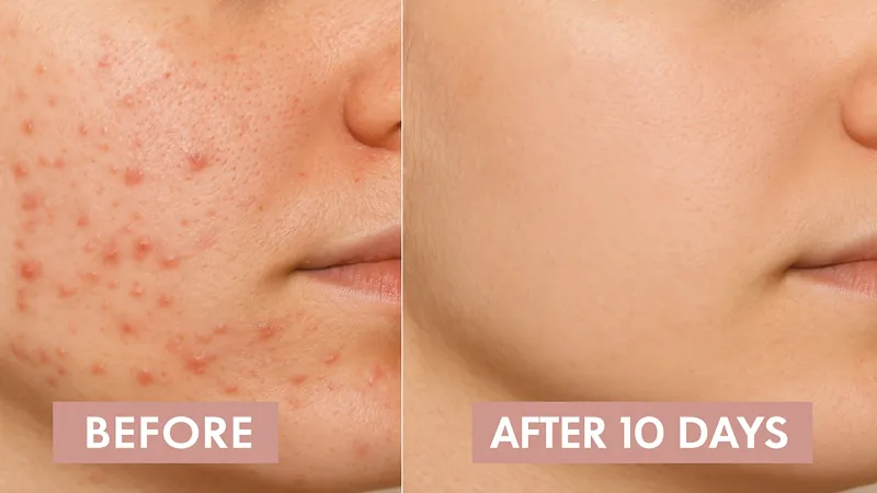 How to use salicylic acid for oily skin